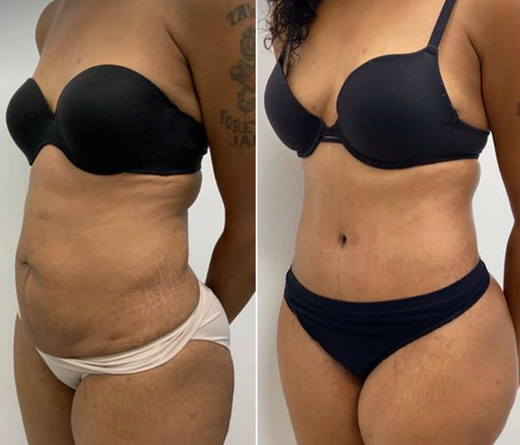 SnatchLift Pro™